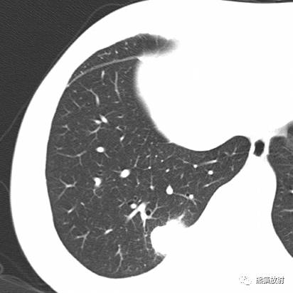 【病例】与肺门及胸膜关系比较密切的肺结核4例CT