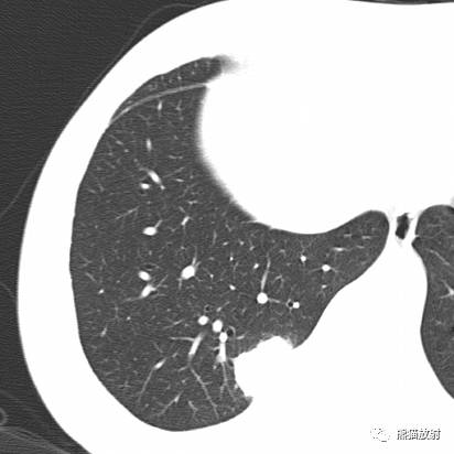 【病例】与肺门及胸膜关系比较密切的肺结核4例CT