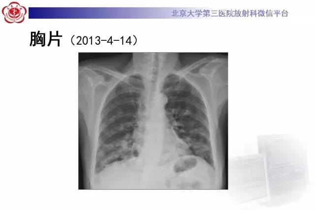 【病例】过敏性肺炎1例CT影像诊断与鉴别