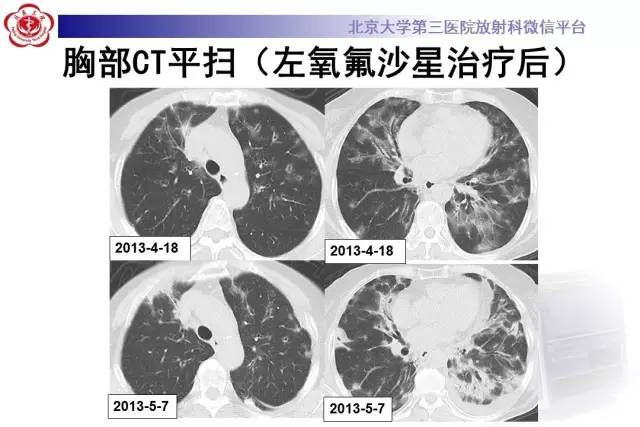 【病例】过敏性肺炎1例CT影像诊断与鉴别