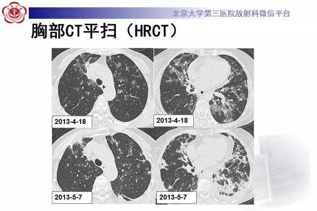 【病例】过敏性肺炎1例CT影像诊断与鉴别
