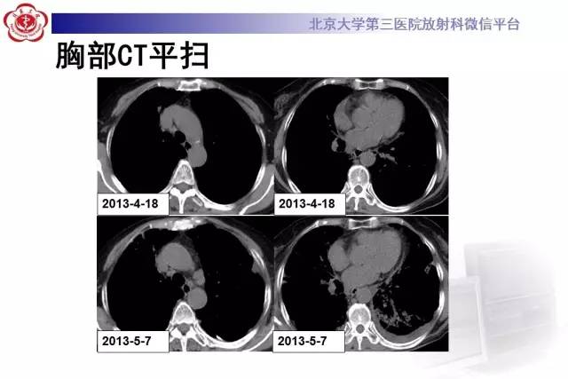 【病例】过敏性肺炎1例CT影像诊断与鉴别