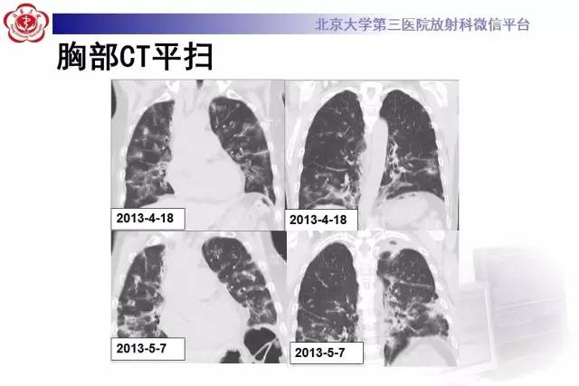 【病例】过敏性肺炎1例CT影像诊断与鉴别