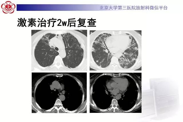 【病例】过敏性肺炎1例CT影像诊断与鉴别