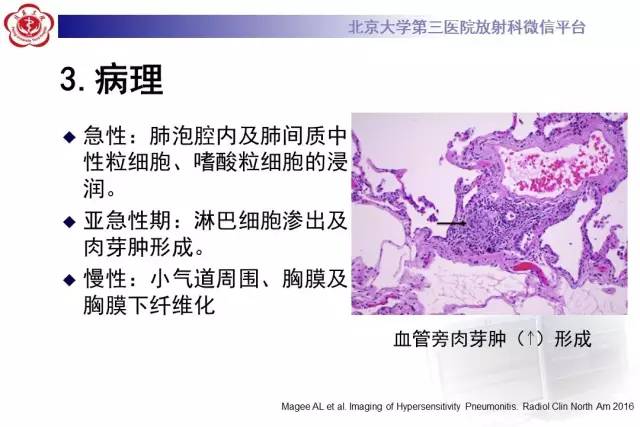 【病例】过敏性肺炎1例CT影像诊断与鉴别
