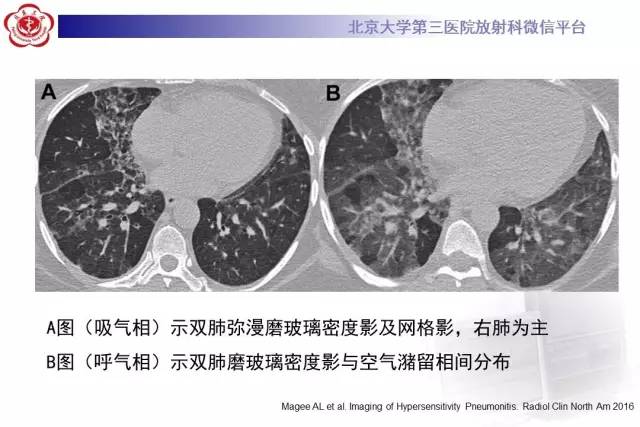 【病例】过敏性肺炎1例CT影像诊断与鉴别