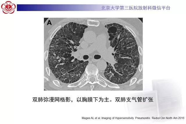 【病例】过敏性肺炎1例CT影像诊断与鉴别