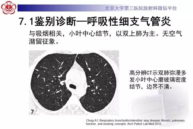 【病例】过敏性肺炎1例CT影像诊断与鉴别