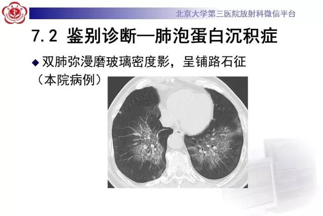 【病例】过敏性肺炎1例CT影像诊断与鉴别