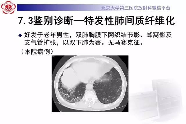 【病例】过敏性肺炎1例CT影像诊断与鉴别