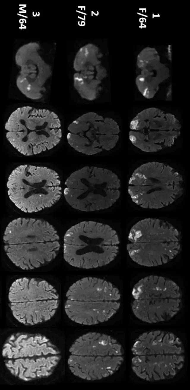 AJNR：DWI病灶累及≥3个血管分布区者20%为恶性肿瘤相关脑梗死