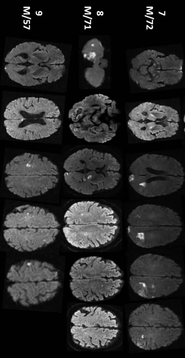 AJNR：DWI病灶累及≥3个血管分布区者20%为恶性肿瘤相关脑梗死