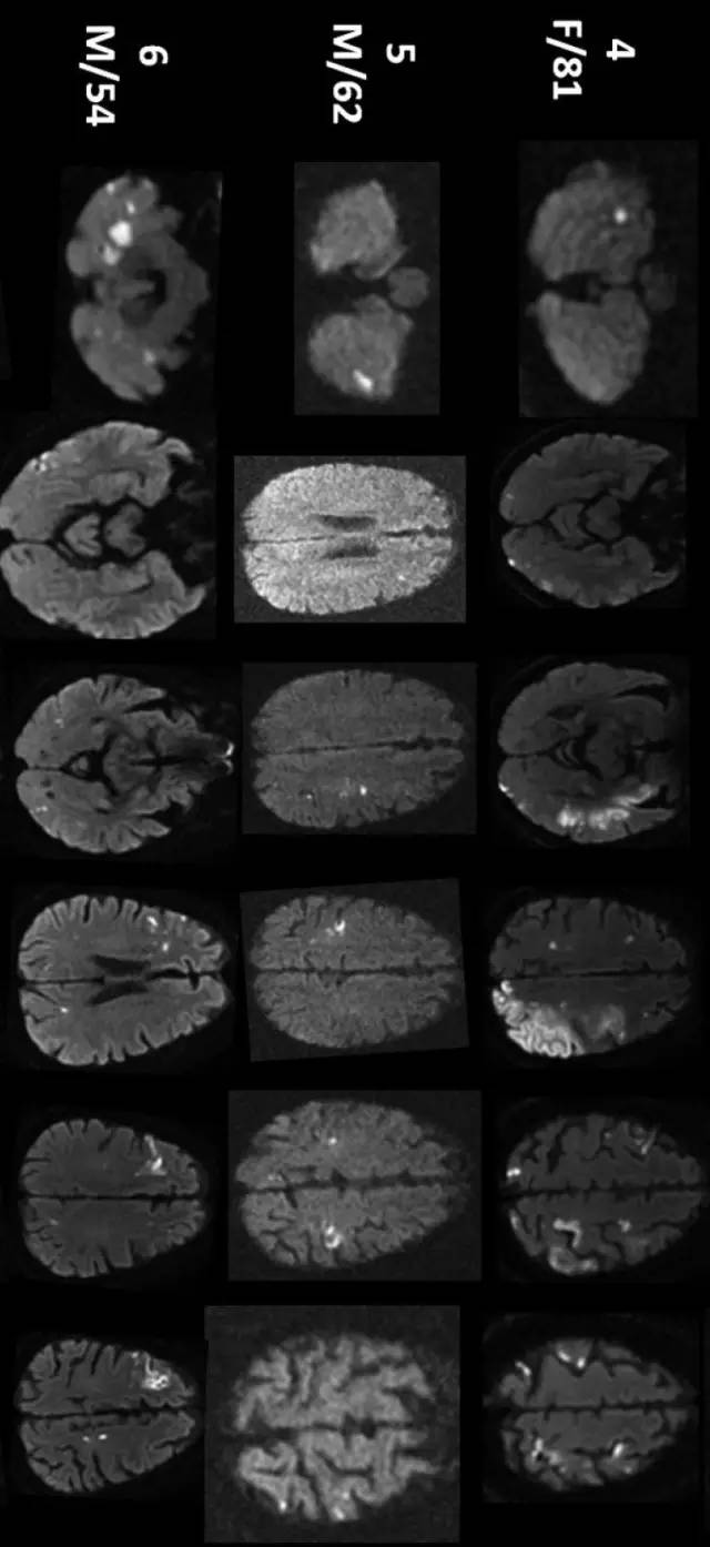 AJNR：DWI病灶累及≥3个血管分布区者20%为恶性肿瘤相关脑梗死