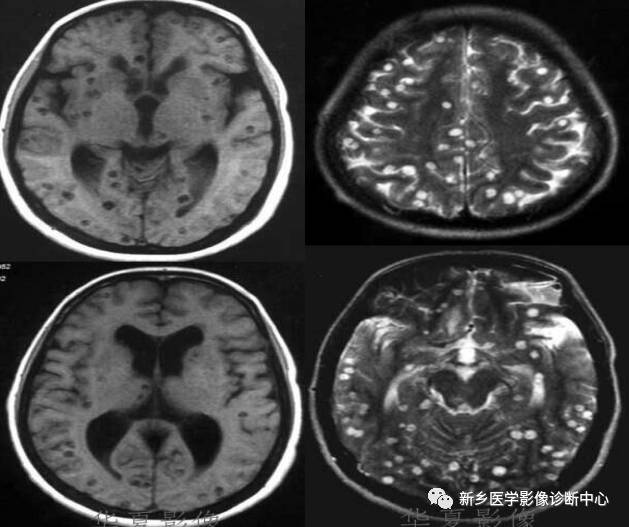 颅内CT平扫低密度应想到的10种病 颅内CT平扫低密度应想到的10种病