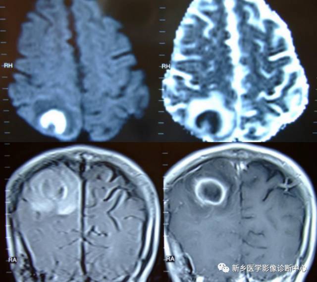 颅内CT平扫低密度应想到的10种病 颅内CT平扫低密度应想到的10种病