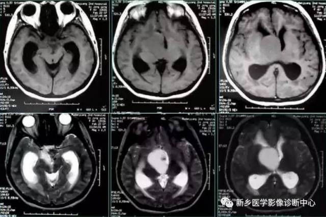 颅内CT平扫低密度应想到的10种病 颅内CT平扫低密度应想到的10种病
