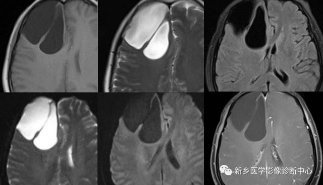 颅内CT平扫低密度应想到的10种病 颅内CT平扫低密度应想到的10种病