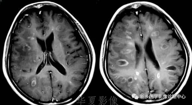 颅内CT平扫低密度应想到的10种病 颅内CT平扫低密度应想到的10种病