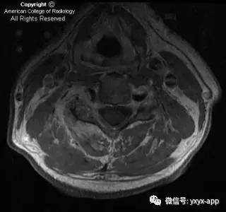 【病例】颈4-5椎小关节脓毒性关节炎1例MRI影像分析