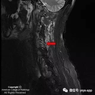【病例】颈4-5椎小关节脓毒性关节炎1例MRI影像分析