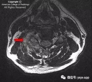 【病例】颈4-5椎小关节脓毒性关节炎1例MRI影像分析