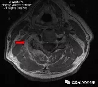 【病例】颈4-5椎小关节脓毒性关节炎1例MRI影像分析