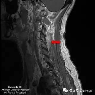 【病例】颈4-5椎小关节脓毒性关节炎1例MRI影像分析