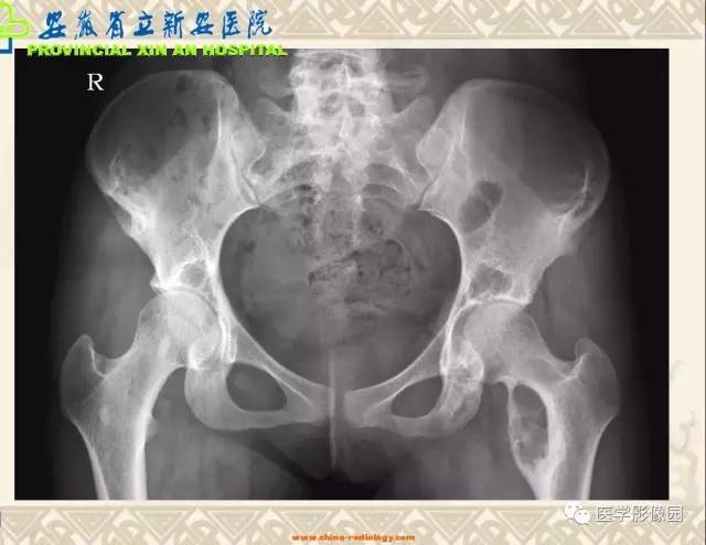 【病例】双髋关节嗜酸性肉芽肿1例X线CT