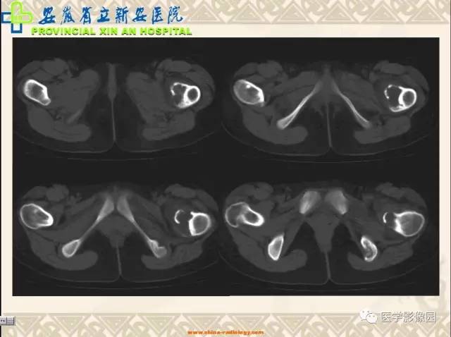 【病例】双髋关节嗜酸性肉芽肿1例X线CT 【病例】双髋关节嗜酸性肉芽肿1例X线CT