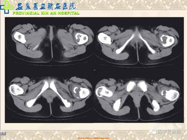 【病例】双髋关节嗜酸性肉芽肿1例X线CT 【病例】双髋关节嗜酸性肉芽肿1例X线CT