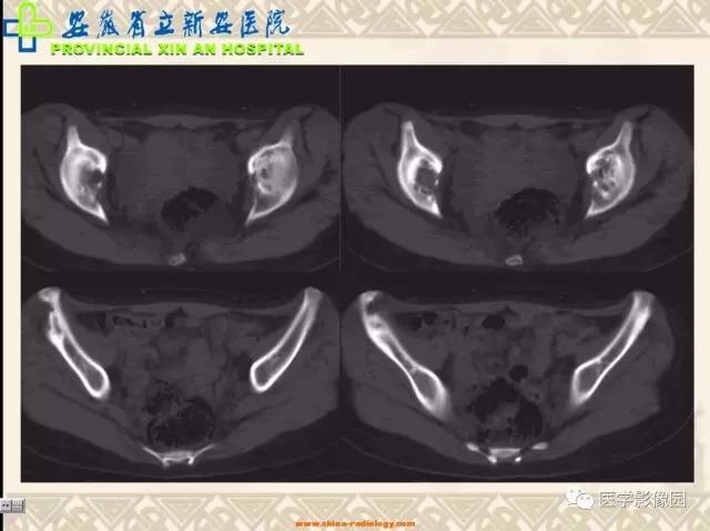 【病例】双髋关节嗜酸性肉芽肿1例X线CT 【病例】双髋关节嗜酸性肉芽肿1例X线CT
