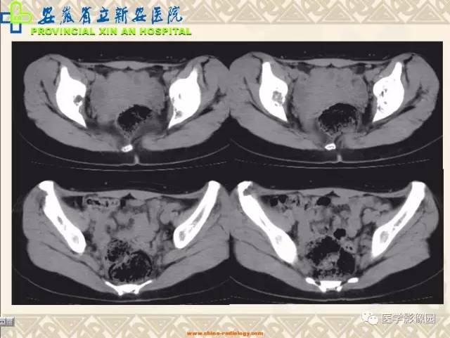 【病例】双髋关节嗜酸性肉芽肿1例X线CT 【病例】双髋关节嗜酸性肉芽肿1例X线CT