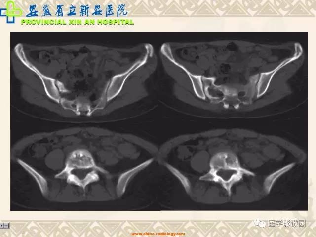【病例】双髋关节嗜酸性肉芽肿1例X线CT 【病例】双髋关节嗜酸性肉芽肿1例X线CT