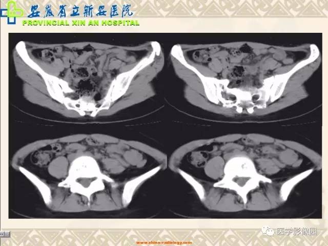 【病例】双髋关节嗜酸性肉芽肿1例X线CT 【病例】双髋关节嗜酸性肉芽肿1例X线CT