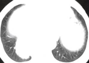 【病例】纵隔恶性孤立性纤维瘤1例CT影像表现 【病例】纵隔恶性孤立性纤维瘤1例CT影像表现