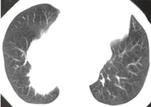 【病例】纵隔恶性孤立性纤维瘤1例CT影像表现 【病例】纵隔恶性孤立性纤维瘤1例CT影像表现