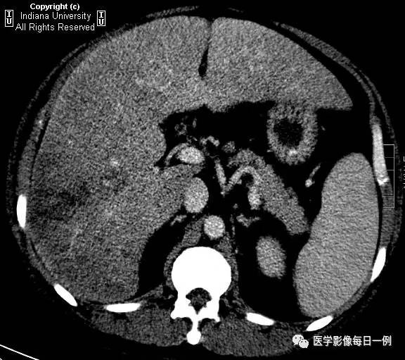 【病例】肝脏局灶性脂肪浸润1例CT及MR
