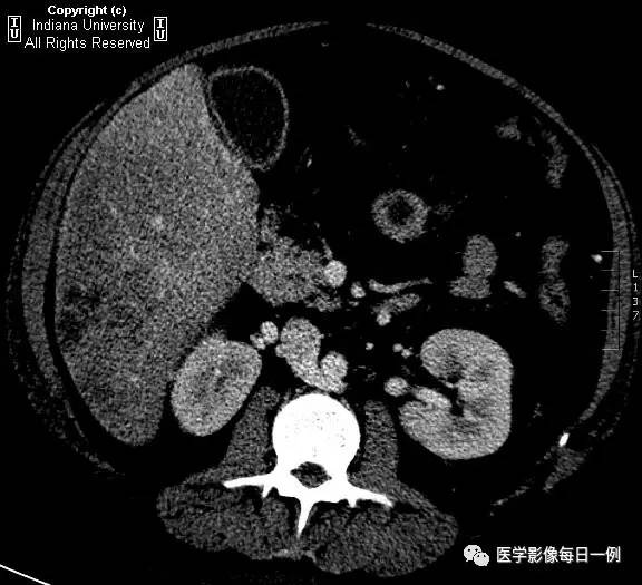 【病例】肝脏局灶性脂肪浸润1例CT及MR 【病例】肝脏局灶性脂肪浸润1例CT及MR