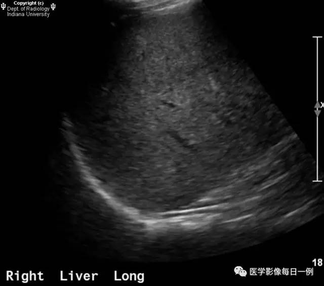 【病例】肝脏局灶性脂肪浸润1例CT及MR 【病例】肝脏局灶性脂肪浸润1例CT及MR