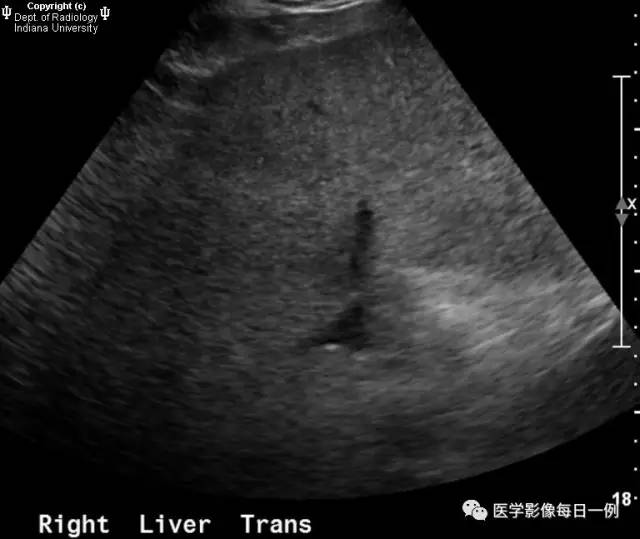 【病例】肝脏局灶性脂肪浸润1例CT及MR 【病例】肝脏局灶性脂肪浸润1例CT及MR