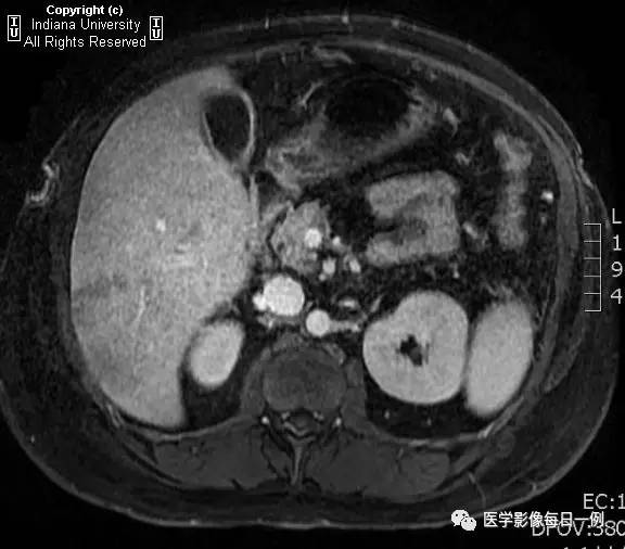 【病例】肝脏局灶性脂肪浸润1例CT及MR 【病例】肝脏局灶性脂肪浸润1例CT及MR