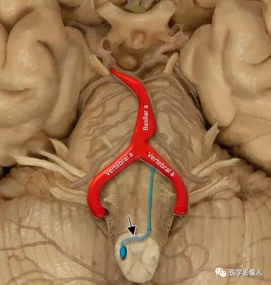 椎基底动脉延长扩张症:临床表现和影像学特点 椎基底动脉延长扩张症:临床表现和影像学特点