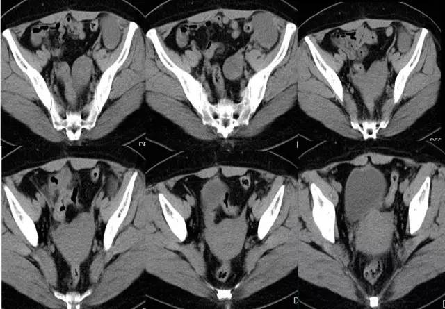 【病例】左腹膜后高级别浆液性腺癌1例CT影像表现