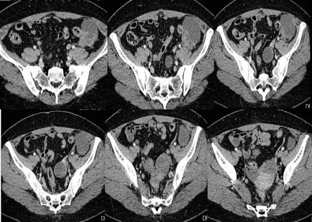 【病例】左腹膜后高级别浆液性腺癌1例CT影像表现
