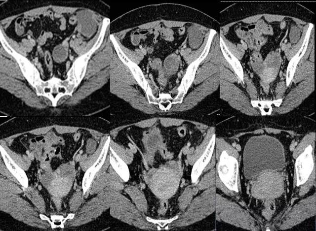【病例】左腹膜后高级别浆液性腺癌1例CT影像表现