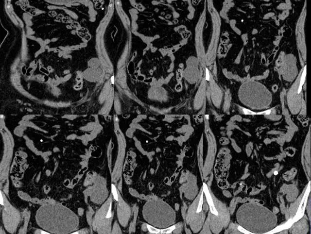 【病例】左腹膜后高级别浆液性腺癌1例CT影像表现