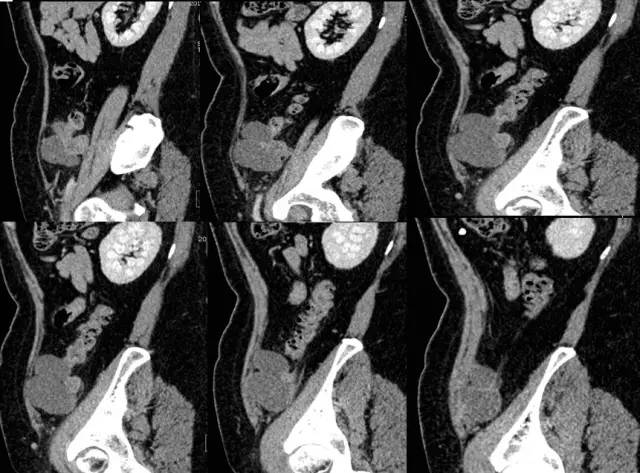 【病例】左腹膜后高级别浆液性腺癌1例CT影像表现