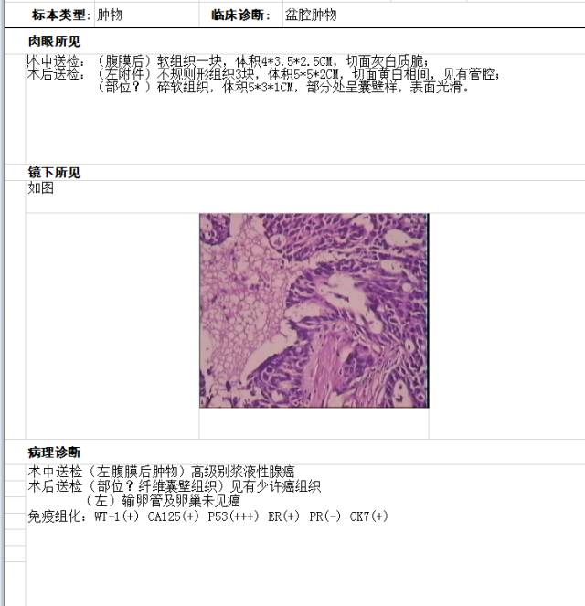 【病例】左腹膜后高级别浆液性腺癌1例CT影像表现
