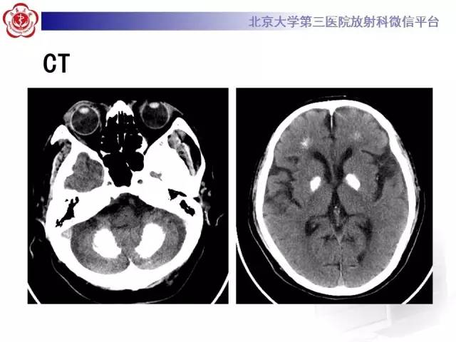 【病例】Fahr病1例CT影像表现与鉴别