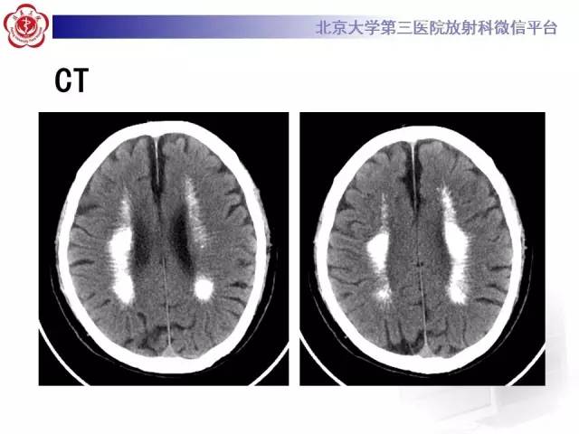 【病例】Fahr病1例CT影像表现与鉴别